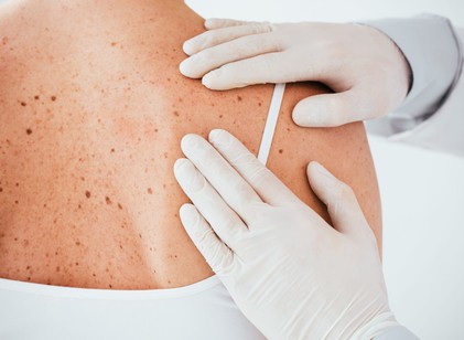 Bőrrák: új diagnosztikai és terápiás eljárásokat fejlesztenek magyar kutatók című cikk nyitóképe